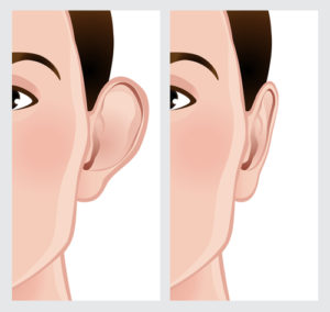 Ear Setback Otoplasty Melbourne - Ear Surgery - Melbourne ENT