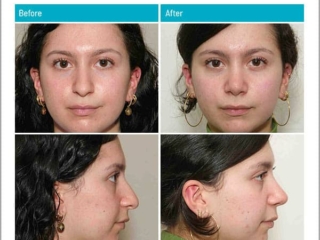 4 Months after Surgery