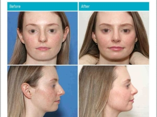 Age 24 - 9 Months After Surgery