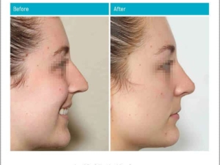 Age 23 - 9 Months After Surgery