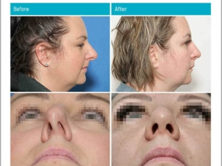 Age 40 - 3 Months After Surgery