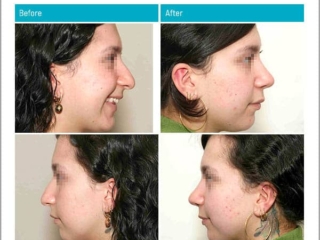 Age 22 - 4 Months After Surgery