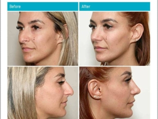 Age 32, 9 Months after Surgery