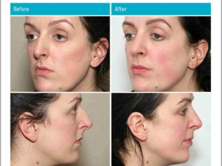 Age 33, 9 Months After Surgery