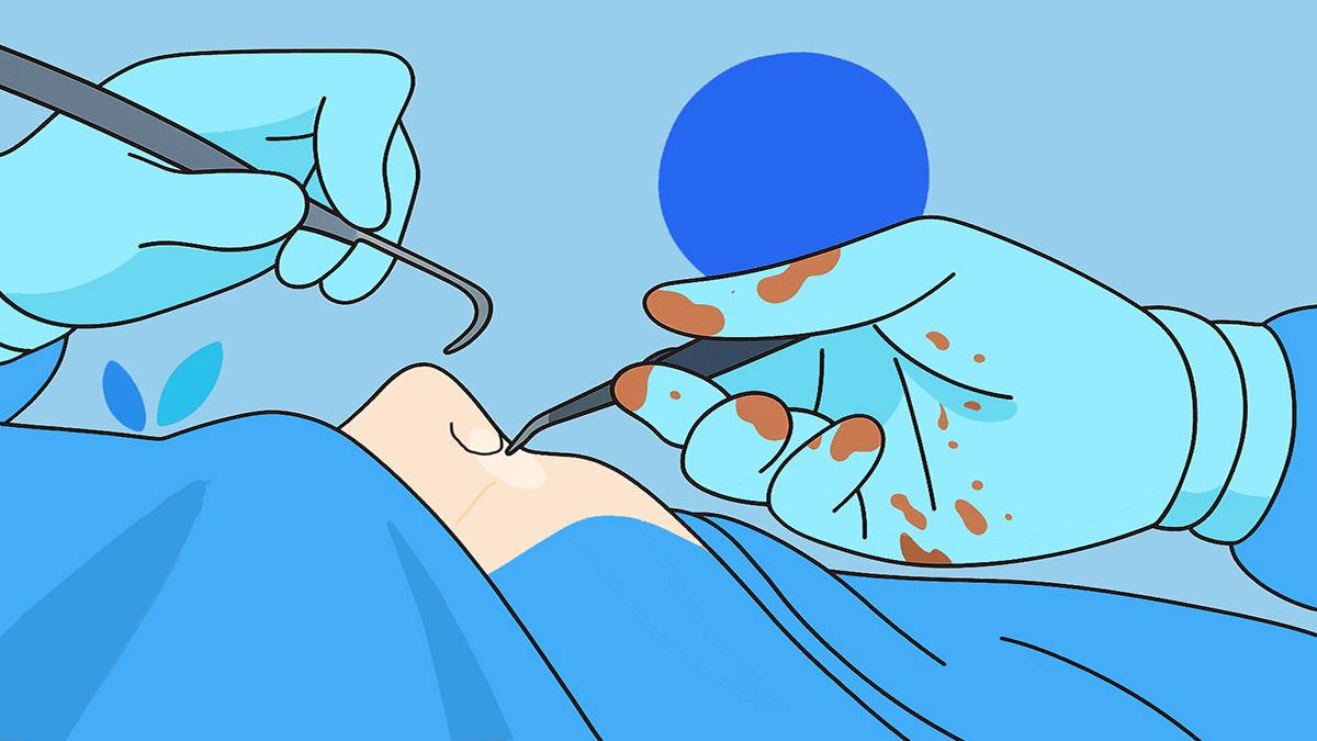 Melbourne ENT Nose Operation Image