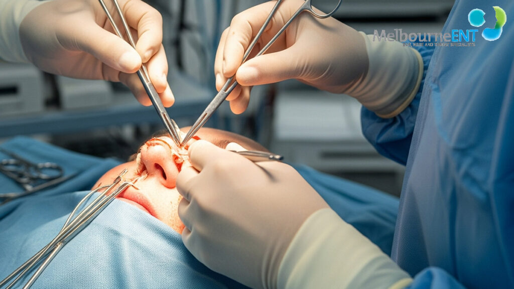 Surgery For a Bulbous Nose Reducing A Bulbous Nose Tip at Melbourne ENT Clinic