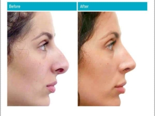 Before and After Rhinoplasty