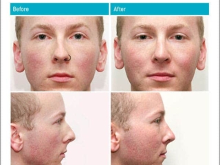 Removal of hump and widening of pinched middle third