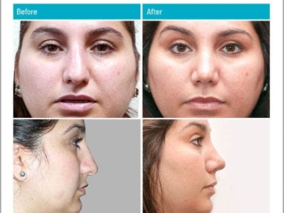 Reduction of projection