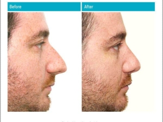 Reduction of Projection