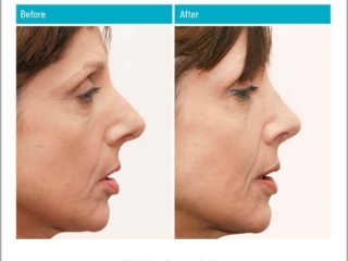 Reduction of over projection