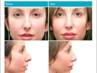 1 week and 2 Years After Surgery