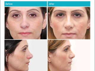 Complex Revision Rhinoplasty