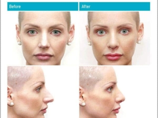 1 week after surgery