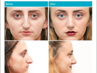 Major change in nasal shape, removing hump and elevating the lip