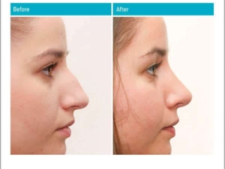 Before and After Rhinoplasty