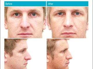 Male Before and After Rhinoplasty
