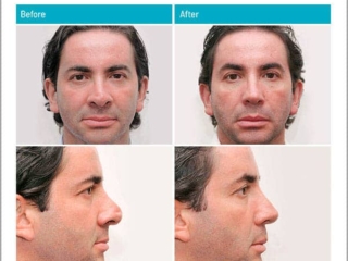 Revision of Polly-beak deformity