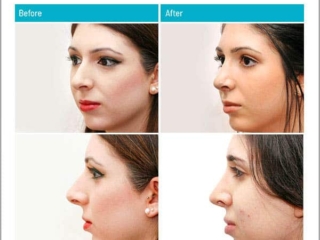 Correction of excessive projection