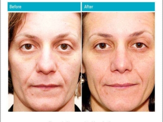 Removal of hump and stuble reduction