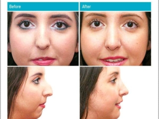 Combination of a rhinoplasty and chin modification