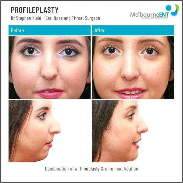 Combination of a rhinoplasty & chin modification Combination of a rhinoplasty & chin modification