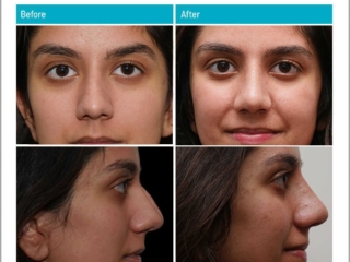 18 to 24 year old woman treated with open rhinoplasty