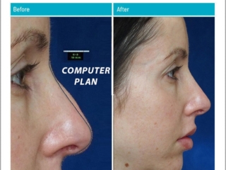 Good natural-looking nose at 2 years post-op, similar to her pre-operative computer plan