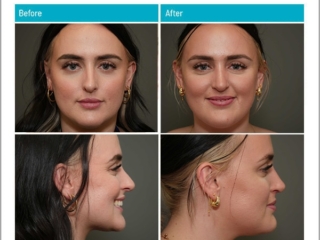 4 weeks after surgery