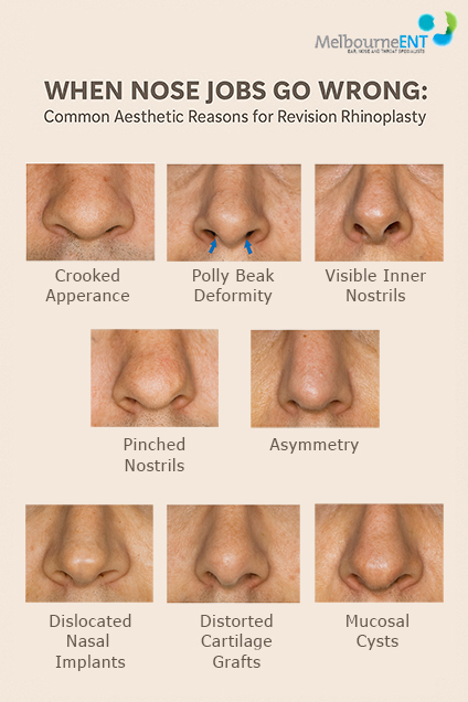 Revision Rhinoplasty at Melbourne ENT Clinic Problem with How The New Nose Looks