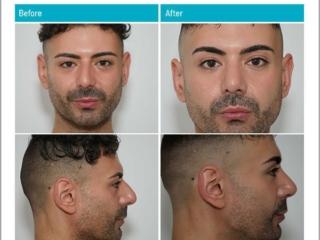 3 Months after surgery