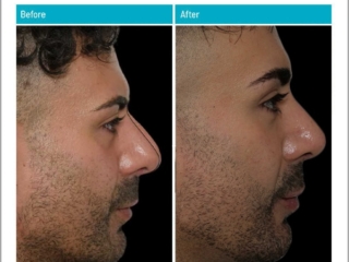 Pre-Operative Computer Plan