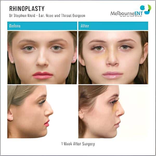 dr-stephen-kleid-rhinoplasty-12-1-600x600 1 week after surgery