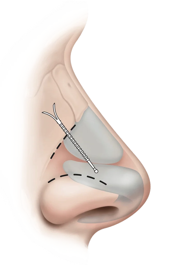 LATERA Nose SideAnatomy Clear