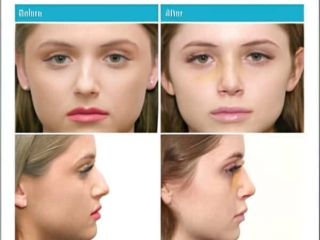 dr-stephen-kleid-rhinoplasty-12-1-600&times;600-1